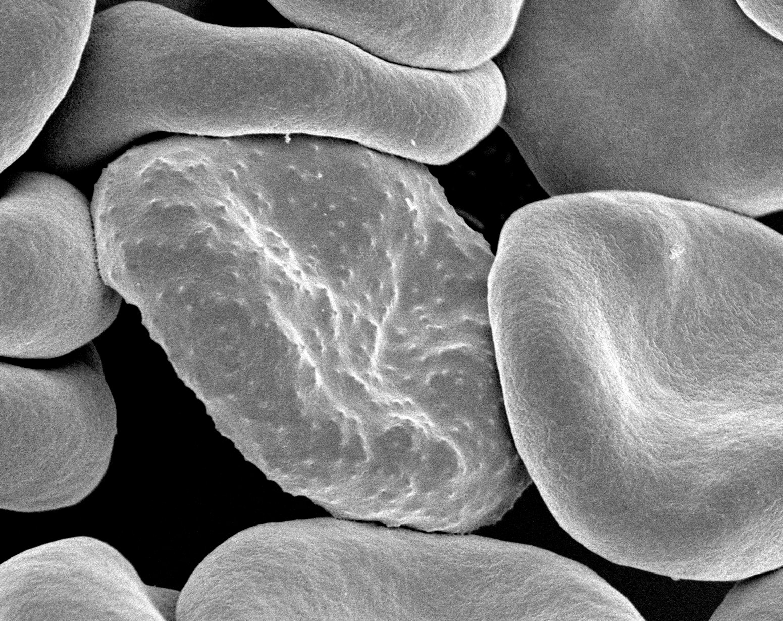 Scanning electron micrograph of a red blood cell infected with the malaria parasite Plasmodium falciparum, surrounded by uninfected cells